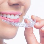 Precio de ortodoncia transparente Invisalign